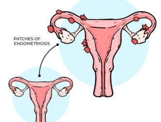 Endometriosis