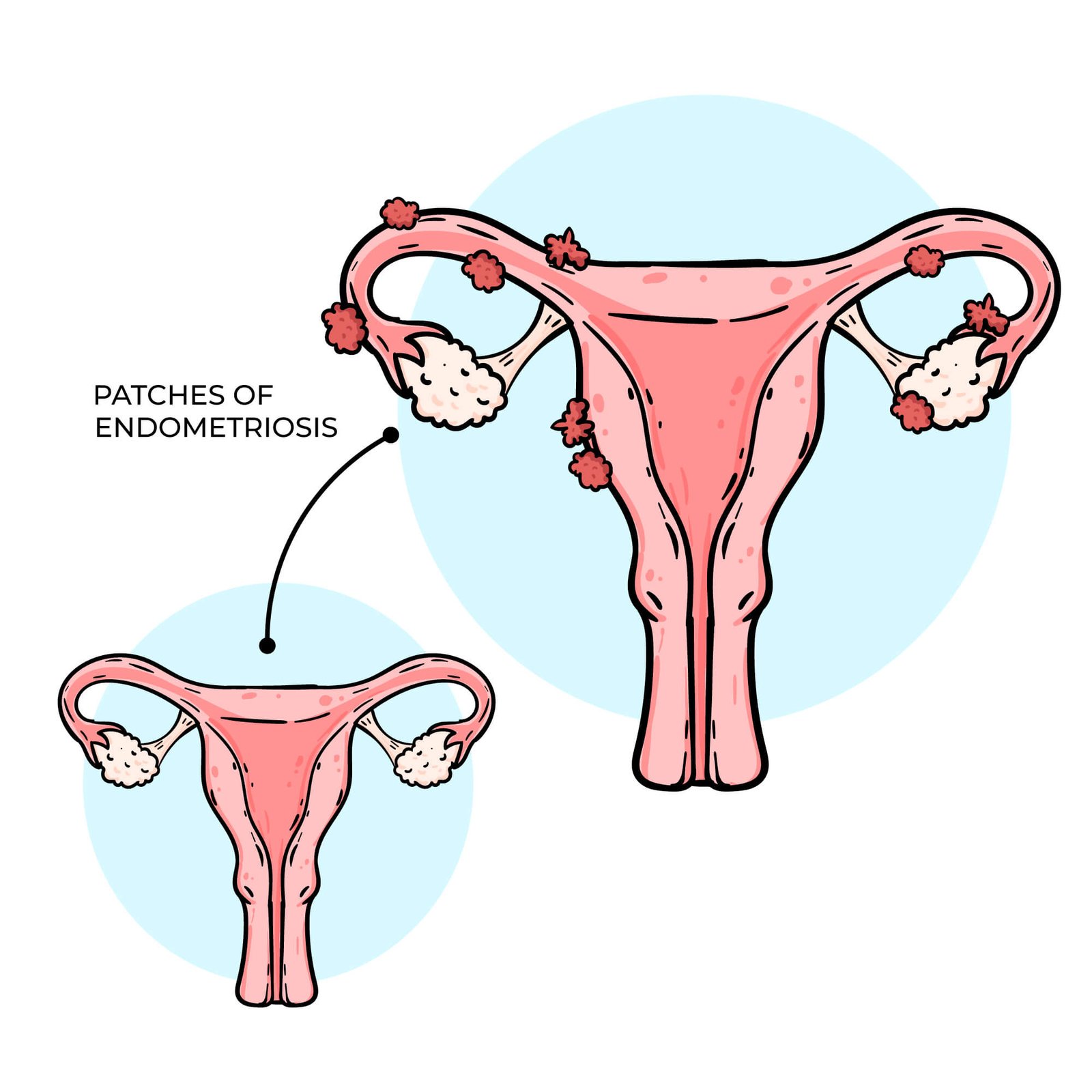 Endometriosis