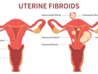 Pregnancy after fibroid surgery