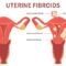 Pregnancy after fibroid surgery