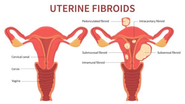 Pregnancy After Fibroid Surgery: What Women in Gurgaon Should Know 1 Pregnancy after fibroid surgery