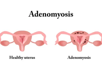 Adenomyosis Surgery in Gurgaon 1