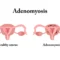 Adenomyosis Surgery in Gurgaon 1