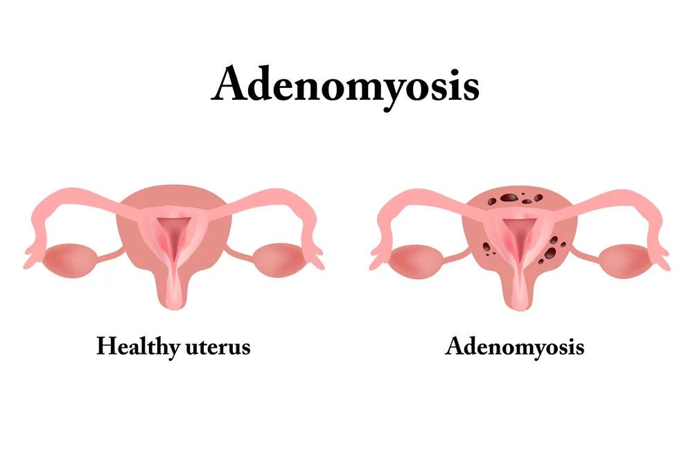 Why Adenomyosis is Often Misdiagnosed – Get Expert Opinion in Gurgaon 1 Adenomyosis Surgery in Gurgaon 1