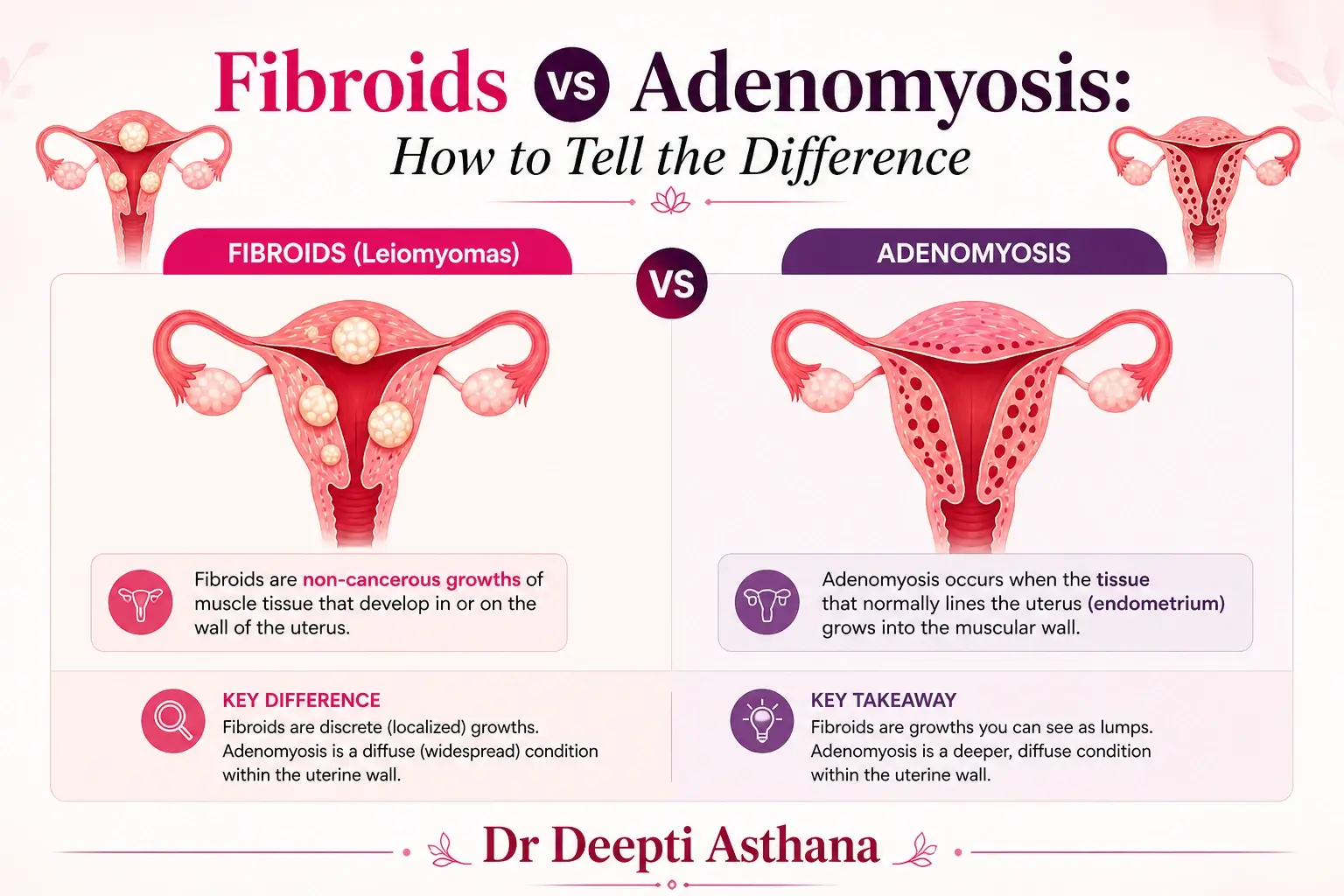 Fibroids vs Adenomyosis: How to Tell the Difference