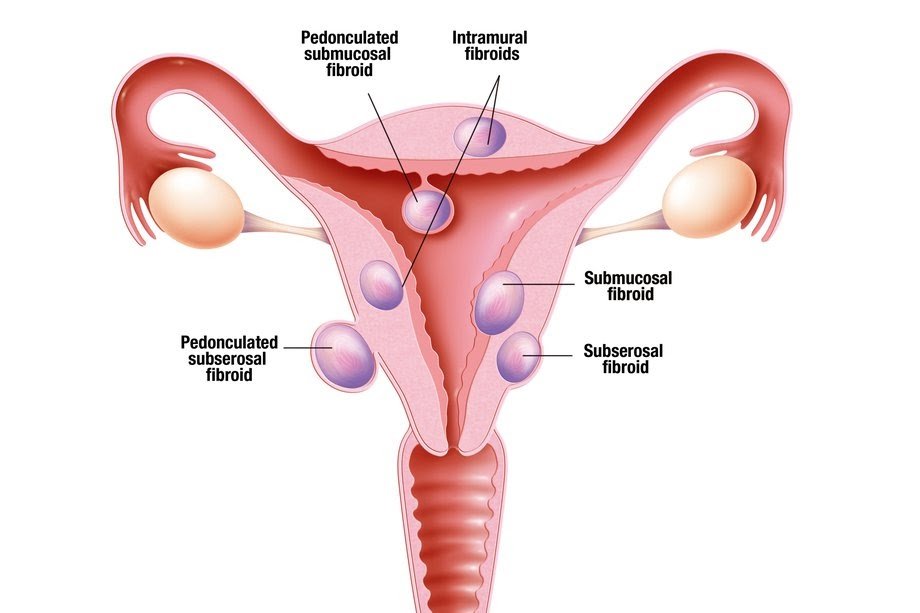 best Fibroid treatment in Gurgaon