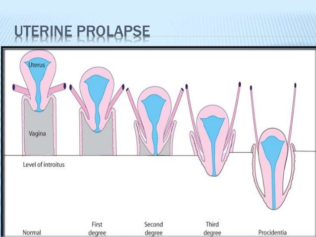 Uterine Prolapse - Punit Fertility & Women's Center